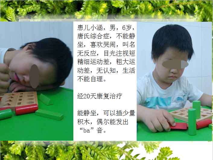 唐氏综合征(一)